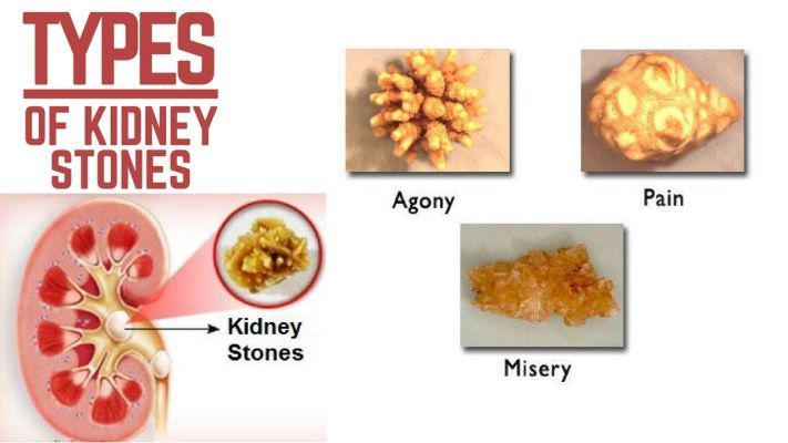 kidney-stones-why-do-i-have-it-dr-shailendra-goel